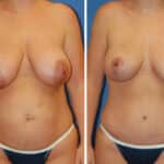 Thumbnail of http://snyder%20before%20and%20after%20breast%20Abdominoplasty%20procedure