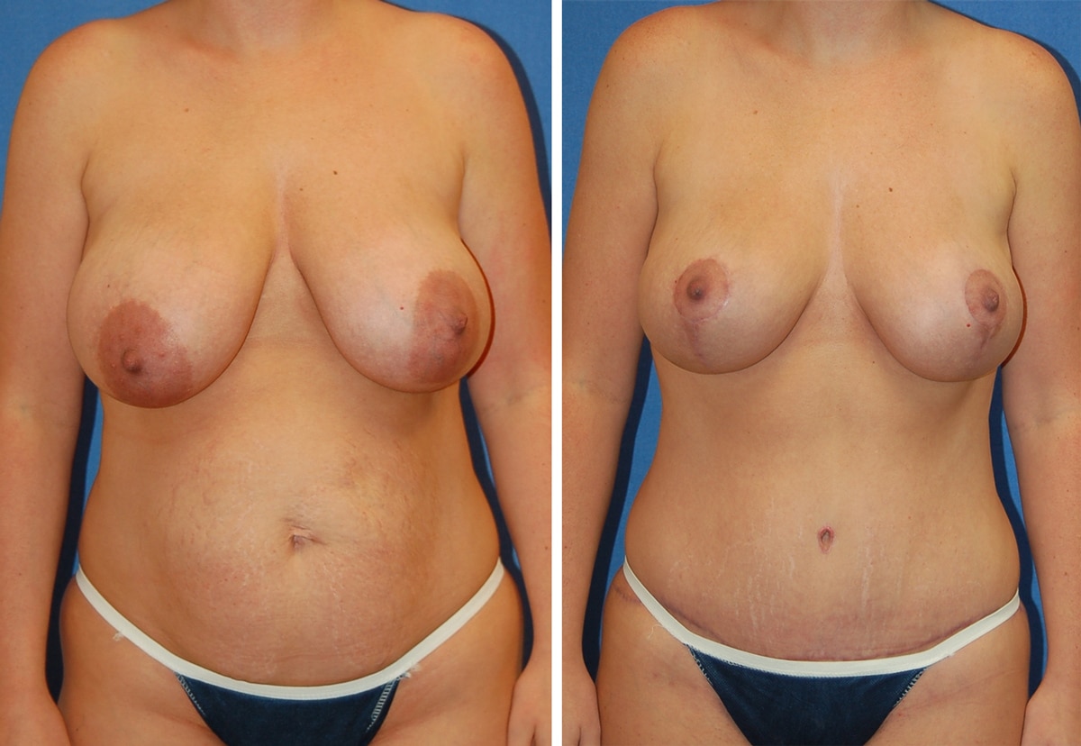 snyder before and after breast Abdominoplasty procedure