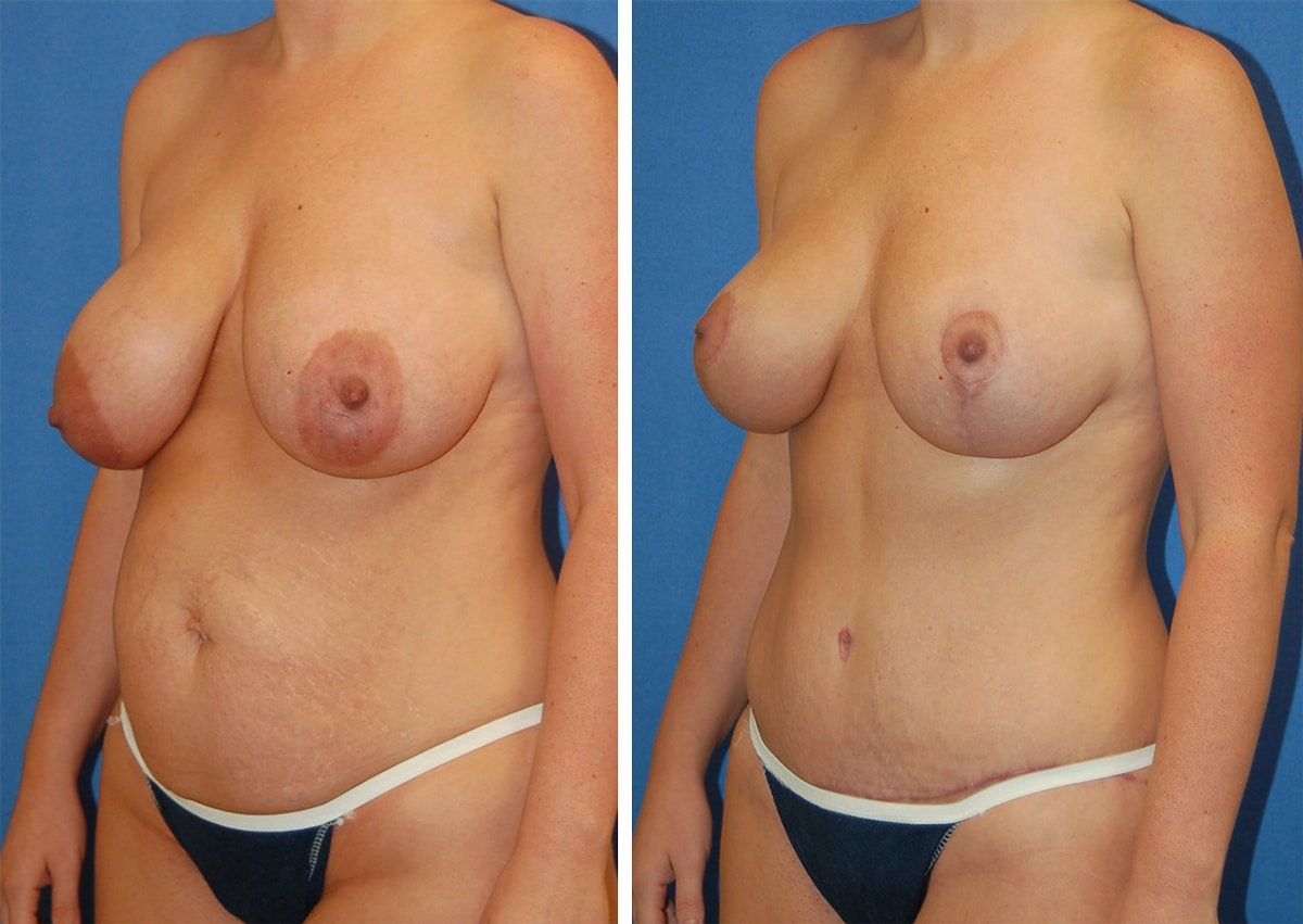 snyder before and after breast Abdominoplasty procedure