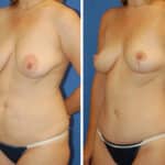 Thumbnail of http://snyder%20before%20and%20after%20breast%20Abdominoplasty%20procedure