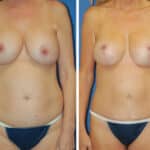 Thumbnail of http://snyder%20before%20and%20after%20breast%20Abdominoplasty%20procedure