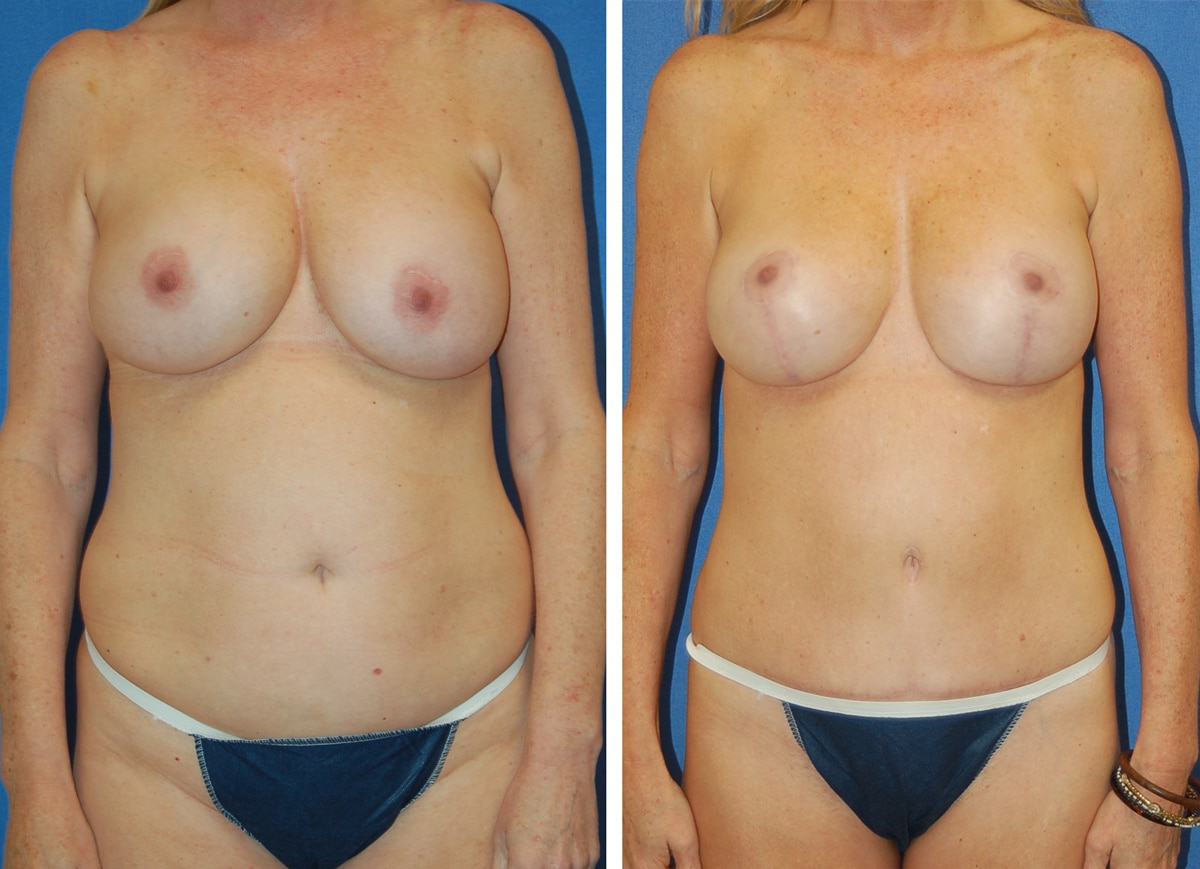snyder before and after breast Abdominoplasty procedure