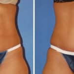 Thumbnail of http://snyder%20before%20and%20after%20breast%20Abdominoplasty%20procedure