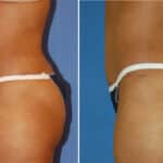 Thumbnail of http://snyder%20before%20and%20after%20breast%20Abdominoplasty%20procedure