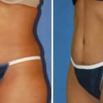 Thumbnail of http://snyder%20before%20and%20after%20breast%20Abdominoplasty%20procedure