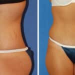 Thumbnail of http://snyder%20before%20and%20after%20breast%20Abdominoplasty%20procedure