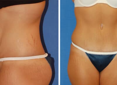 Abdominoplasty Patient – 2