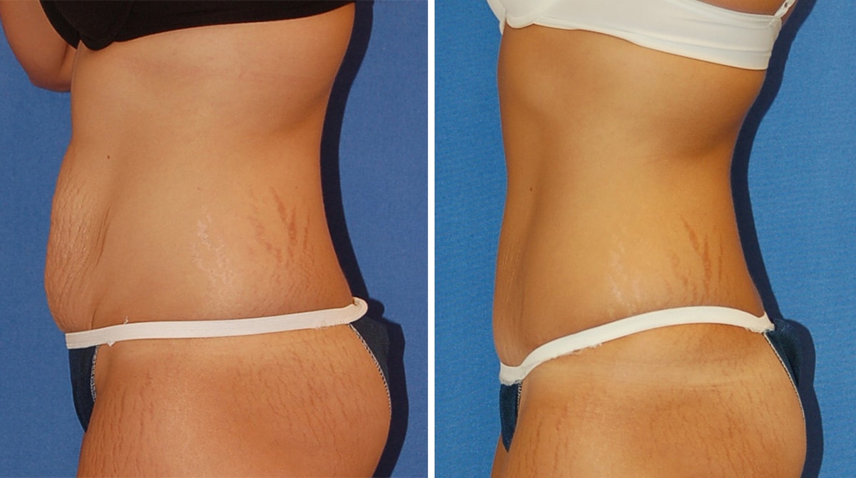 snyder before and after breast Abdominoplasty procedure
