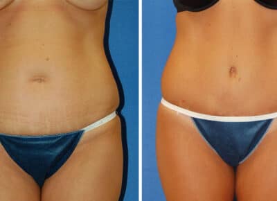 Abdominoplasty Patient – 4