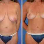 Thumbnail of http://snyder%20before%20and%20after%20breast%20Abdominoplasty%20procedure