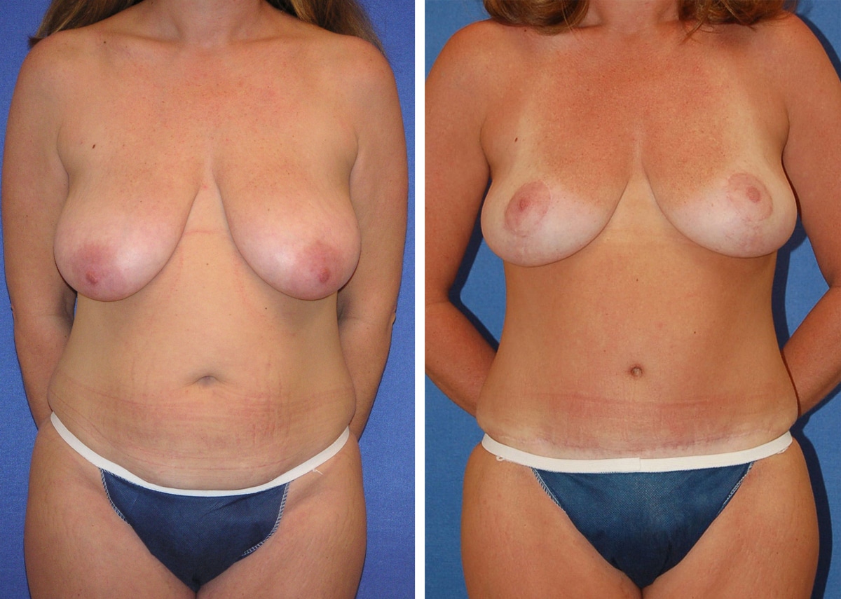 snyder before and after breast Abdominoplasty procedure