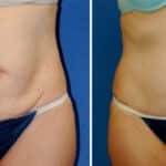 Thumbnail of http://snyder%20before%20and%20after%20breast%20Abdominoplasty%20procedure