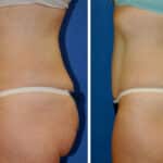 Thumbnail of http://snyder%20before%20and%20after%20breast%20Abdominoplasty%20procedure