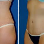 Thumbnail of http://snyder%20before%20and%20after%20breast%20Abdominoplasty%20procedure