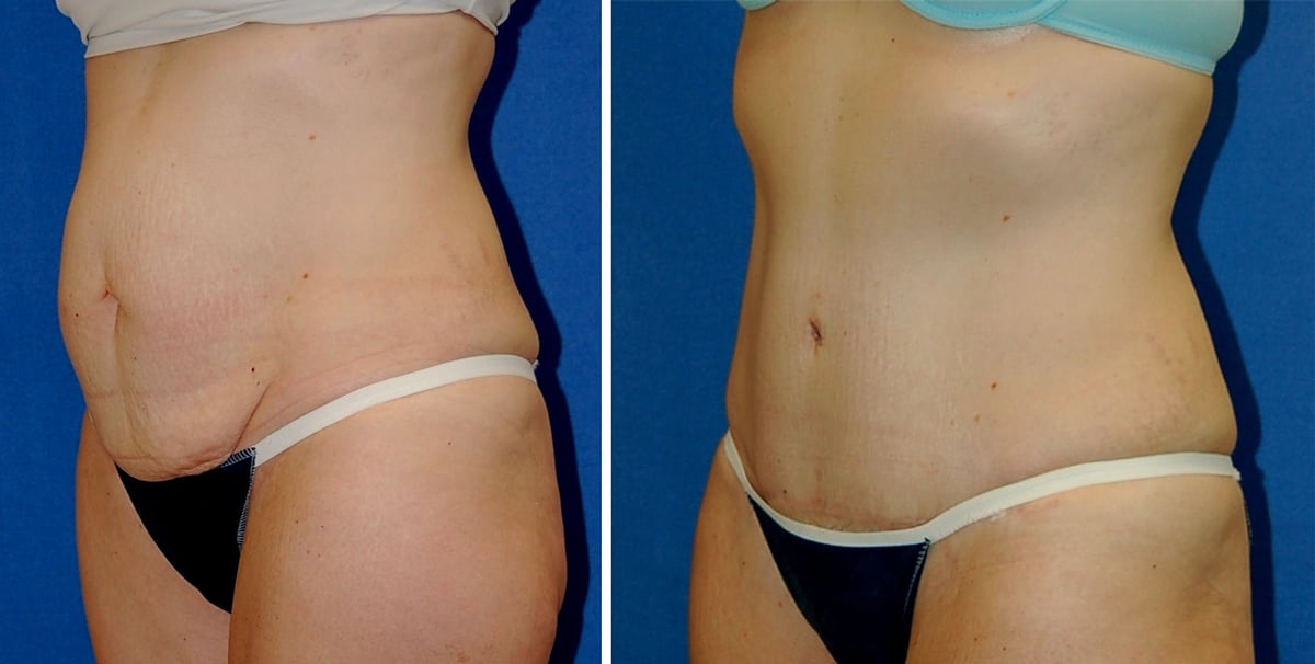 snyder before and after breast Abdominoplasty procedure