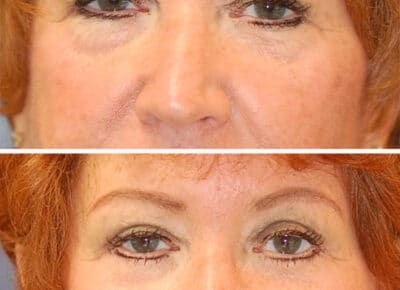 Blepharoplasty Patient – 12