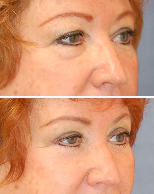 blepharoplasty before and after patient