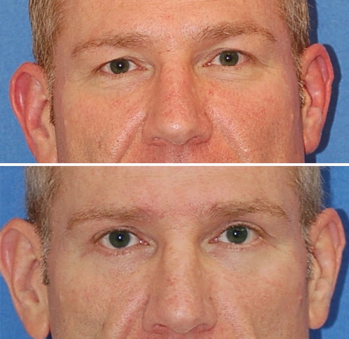 blepharoplasty before and after patient