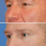 Thumbnail of http://blepharoplasty%20before%20and%20after%20patient