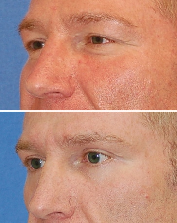 blepharoplasty before and after patient