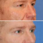 Thumbnail of http://blepharoplasty%20before%20and%20after%20patient