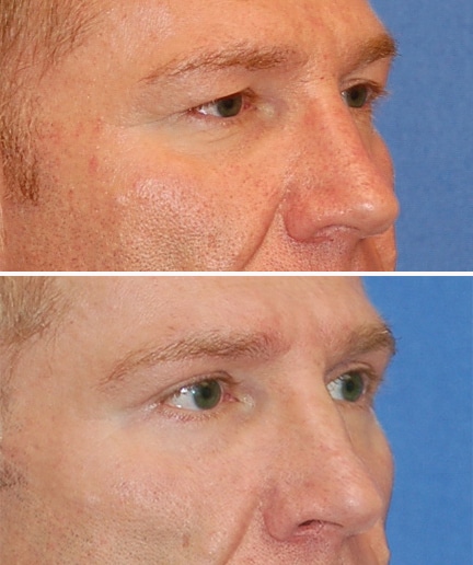 blepharoplasty before and after patient