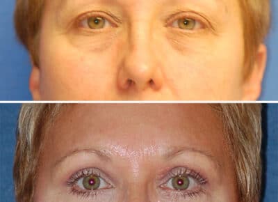 Blepharoplasty Patient – 9