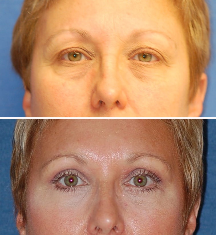 blepharoplasty before and after patient