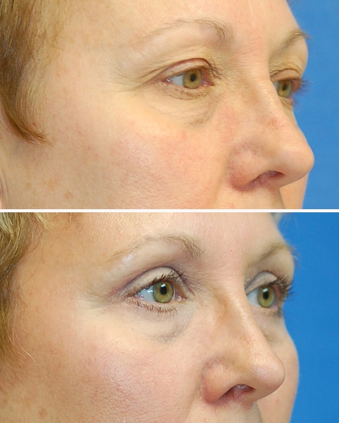 blepharoplasty before and after patient