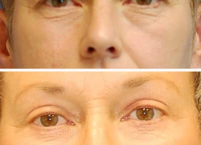 Blepharoplasty Patient – 2