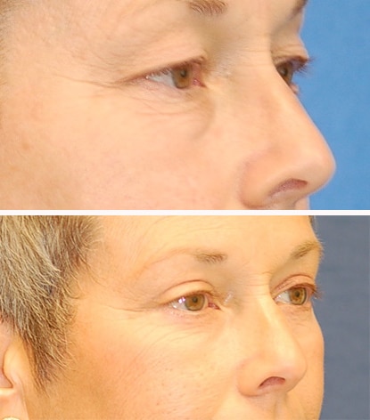 blepharoplasty before and after patient
