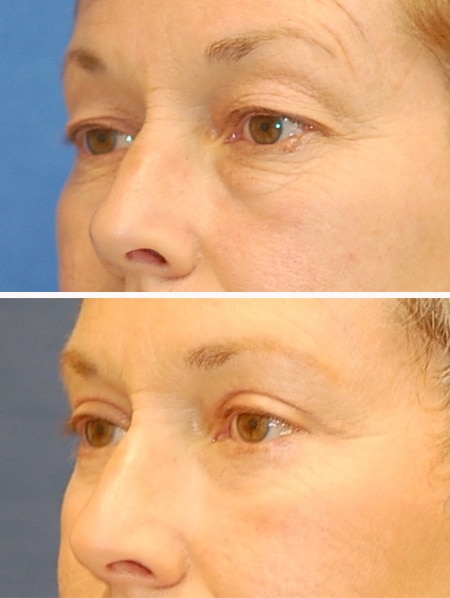 blepharoplasty before and after patient