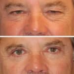 Thumbnail of http://blepharoplasty%20before%20and%20after%20patient