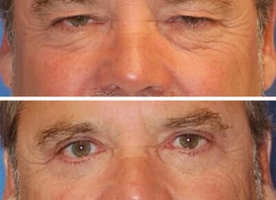 Blepharoplasty Patient – 3