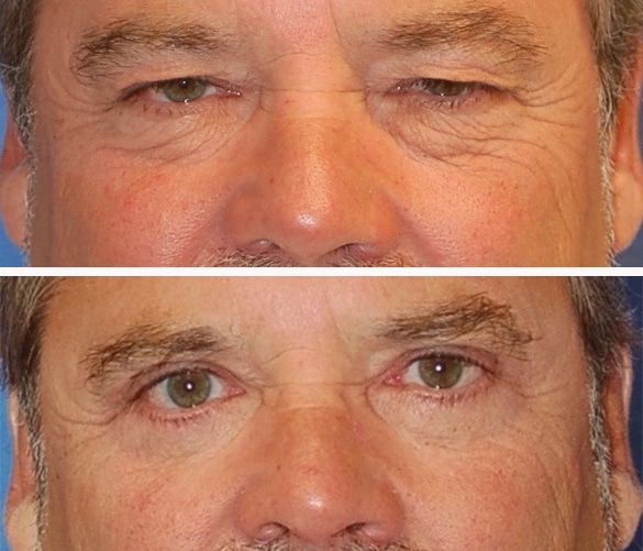 blepharoplasty before and after patient