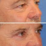 Thumbnail of http://blepharoplasty%20before%20and%20after%20patient