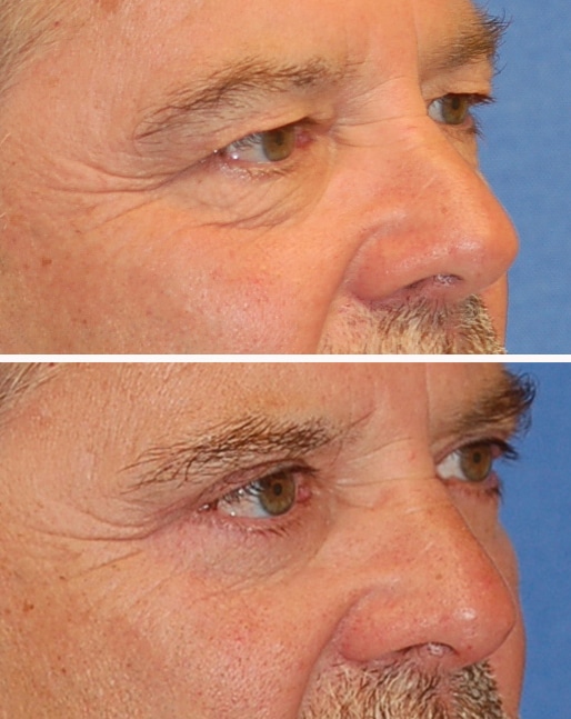 blepharoplasty before and after patient