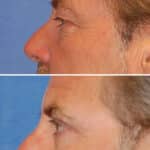 Thumbnail of http://blepharoplasty%20before%20and%20after%20patient