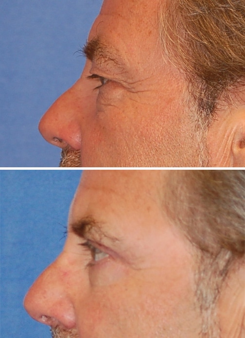 blepharoplasty before and after patient