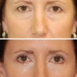 Thumbnail of http://blepharoplasty%20before%20and%20after%20patient