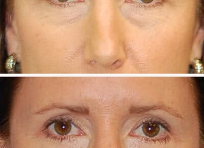 Blepharoplasty Patient – 4