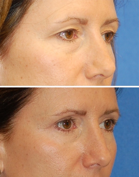 blepharoplasty before and after patient