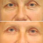 Thumbnail of http://blepharoplasty%20before%20and%20after%20patient