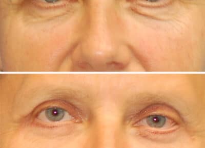 Blepharoplasty Patient – 10