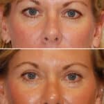 Thumbnail of http://blepharoplasty%20before%20and%20after%20patient