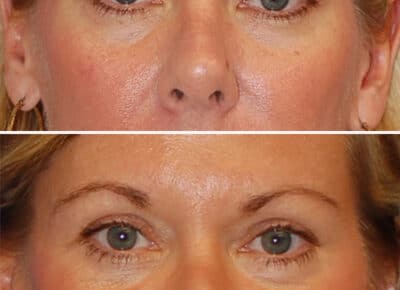 Blepharoplasty Patient – 5