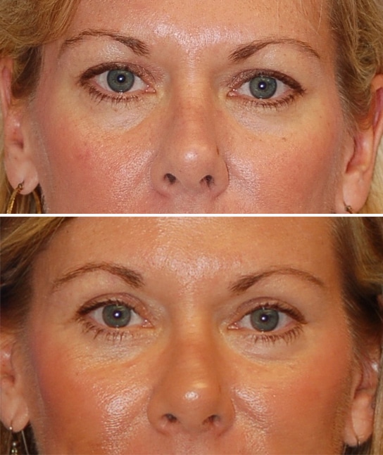 blepharoplasty before and after patient