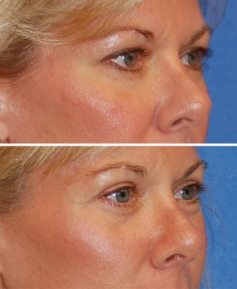 blepharoplasty before and after patient