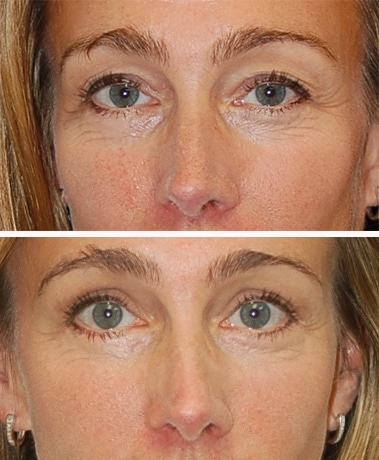 blepharoplasty before and after patient