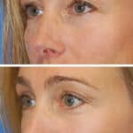 Thumbnail of http://blepharoplasty%20before%20and%20after%20patient